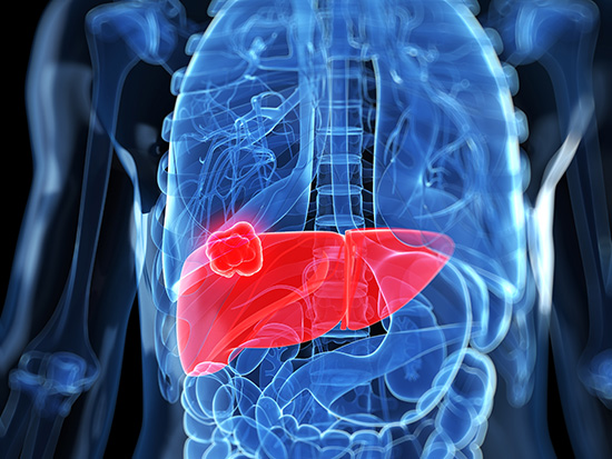 Liver Cancer image