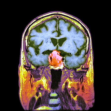 Pituitary tumor, CT scan