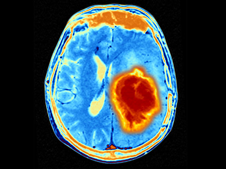 Brain tumour. Coloured Magnetic Resonance Imaging (MRI) scan of an axial section through the brain showing a metastatic tumour. At bottom left is the tumour (red-yellow) This tumour occurs within one cerebral hemisphere; the other hemisphere is at right. The eyeballs - not visible -are at top. Metastatic cancer is a secondary disease spread from cancer elsewhere in the body. Metastatic brain tumours are malignant. Typically they cause brain compression and nerve damage