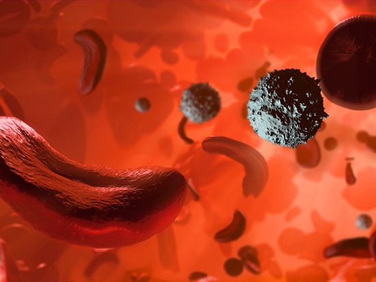 Sickle cell anaemia, illustration