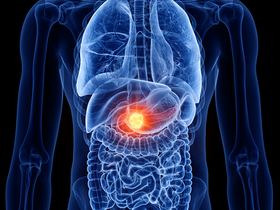 Pancreatic Cancer x-ray