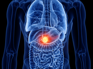 Pancreatic Cancer x-ray