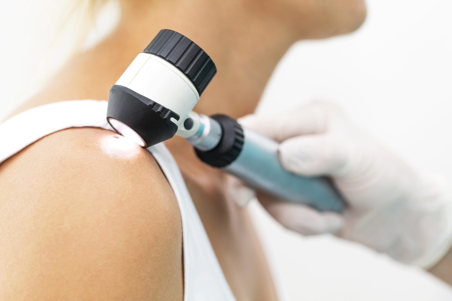 Doctor examining melanoma using dermatoscope