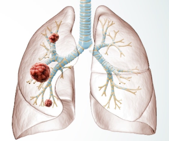 Illustration of lungs, one side with cancerous cells